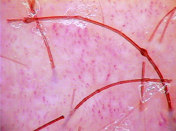 Trichorrhexis Invaginata and Netherton’s Syndrome | SpringerLink