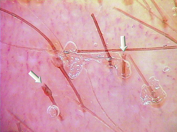 Trichorrhexis Invaginata and Netherton’s Syndrome | SpringerLink