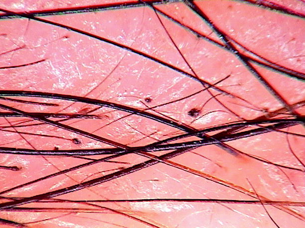 Trichorrhexis Invaginata and Netherton’s Syndrome | SpringerLink