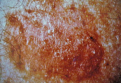 Geriatric Dermatology: Overview  SpringerLink