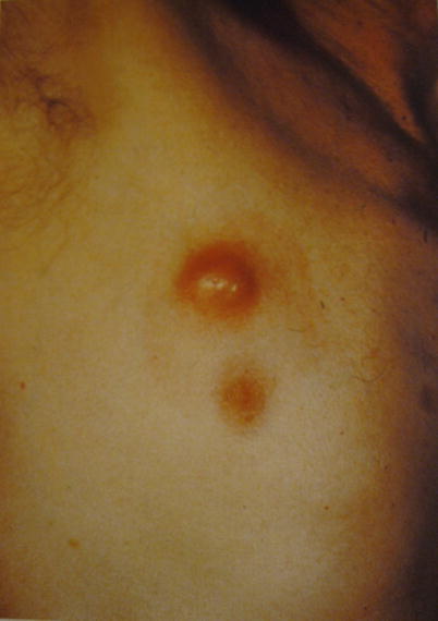 Cysts Springerlink