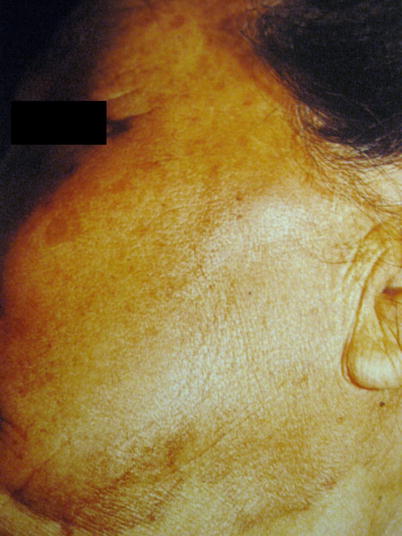 icd 10 angiosarcoma