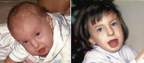 Chromosomal Anomalies Associated With Congenital Heart Disease Springerlink