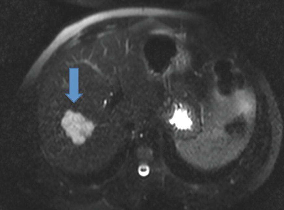 Tumors of the Liver | SpringerLink