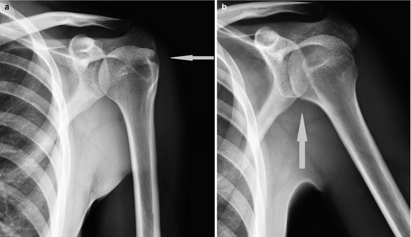 Imaging of the Shoulder | SpringerLink