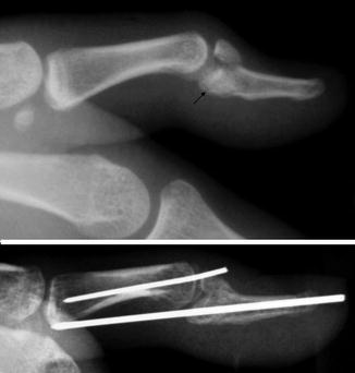 Acute Thumb and Finger Instability | SpringerLink