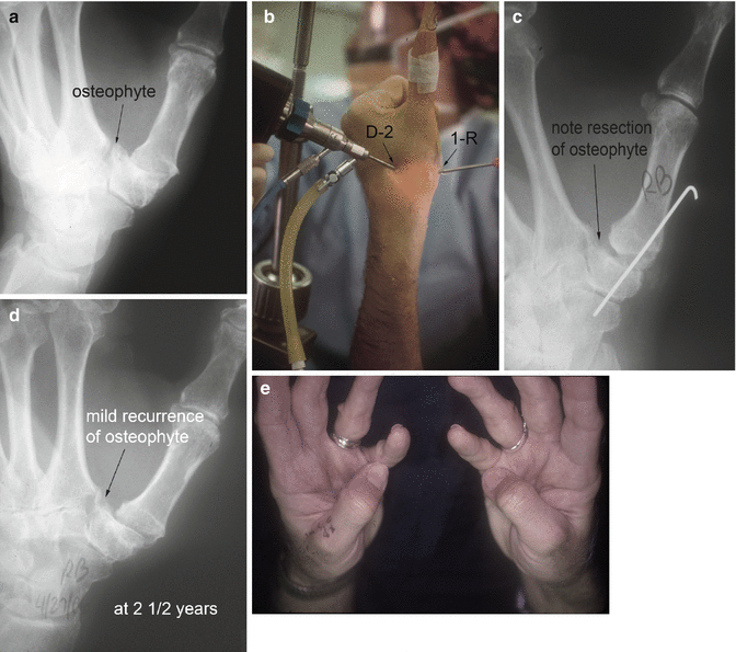 Osteoarthritis of the Thumb SpringerLink