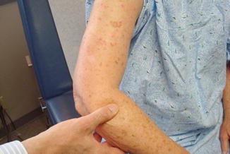 Collagen Vascular Diseases and Cutaneous Drug Reactions | SpringerLink Collagen Vascular Diseases and Cutaneous Drug Reactions | SpringerLink