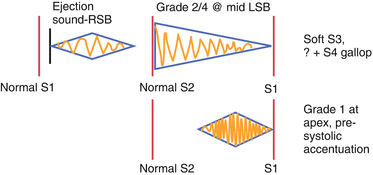 The Austin Flint Murmur Springerlink