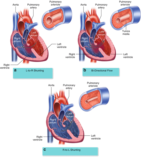 Patent Ductus Arteriosus 