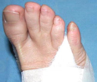 correcting soft corns