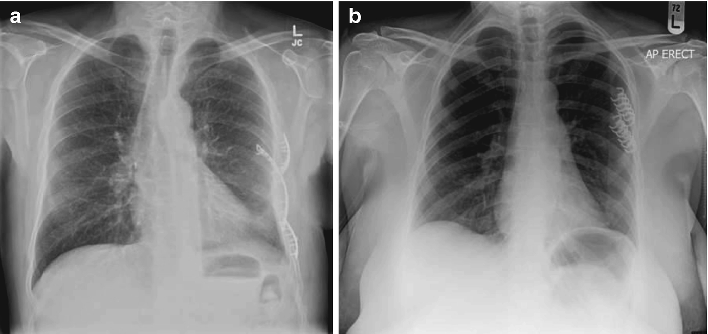 Blunt Thoracic Trauma | SpringerLink