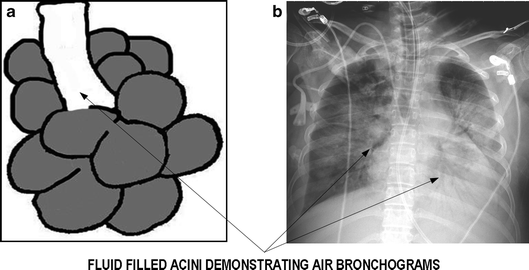Air Space Disease | SpringerLink