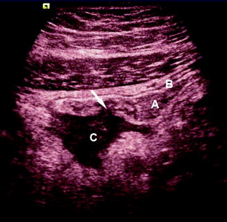 Ultrasound in Inflammatory Bowel Disease | SpringerLink