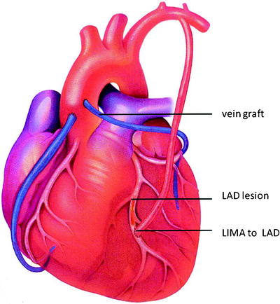 surgical treatment of coronary artery disease springerlink