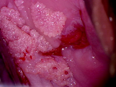 papiloma virus tratamiento papiloma puroiau