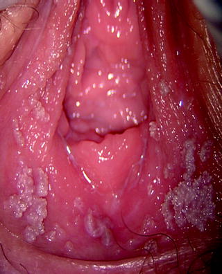 vestibular papillae vs genital warts condilom ceea ce este la bărbați