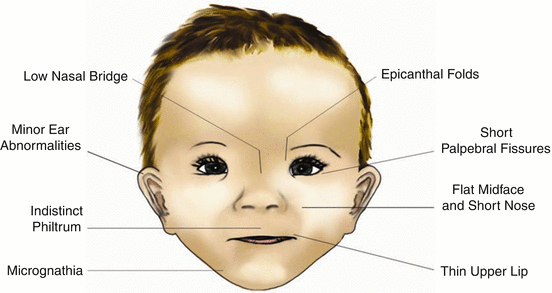 Fetal Alcohol Syndrome Springerlink