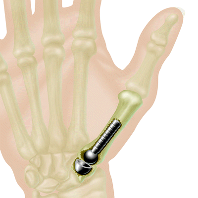 surgical options for failed thumb basal joint arthroplasty
