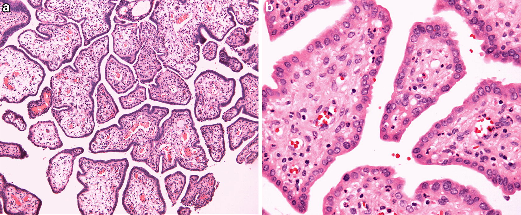mullerian papilloma parazitii pestelui