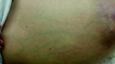 Cirrhosis Dermatological Features Springerlink