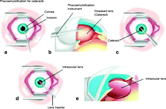 the eye and its
