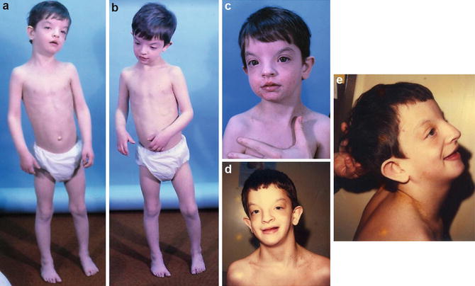 Wolf Hirschhorn Syndrome Springerlink