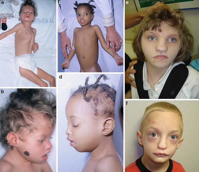 Wolf Hirschhorn Syndrome Springerlink