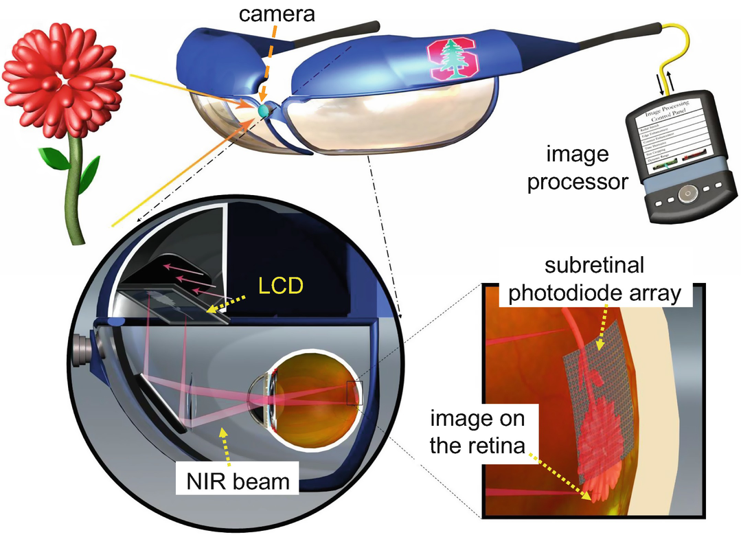 Visual Prosthesis, Optoelectronic Devices SpringerLink
