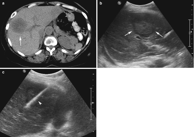 Liver Biopsy SpringerLink