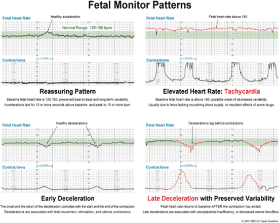 Emergent Cesarean Section Springerlink