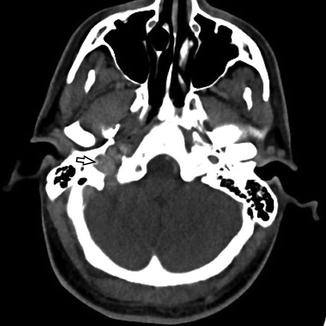 Jugular Vein Thrombosis Springerlink