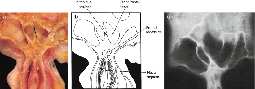 Anatomy Of The Nose And Paranasal Sinuses Springerlink Anatomy Of The Nose And Paranasal Sinuses Springerlink