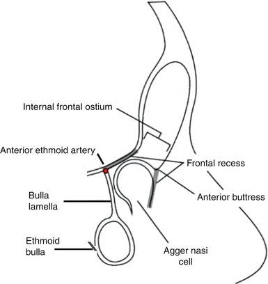 Chronic Frontal Sinusitis | SpringerLink