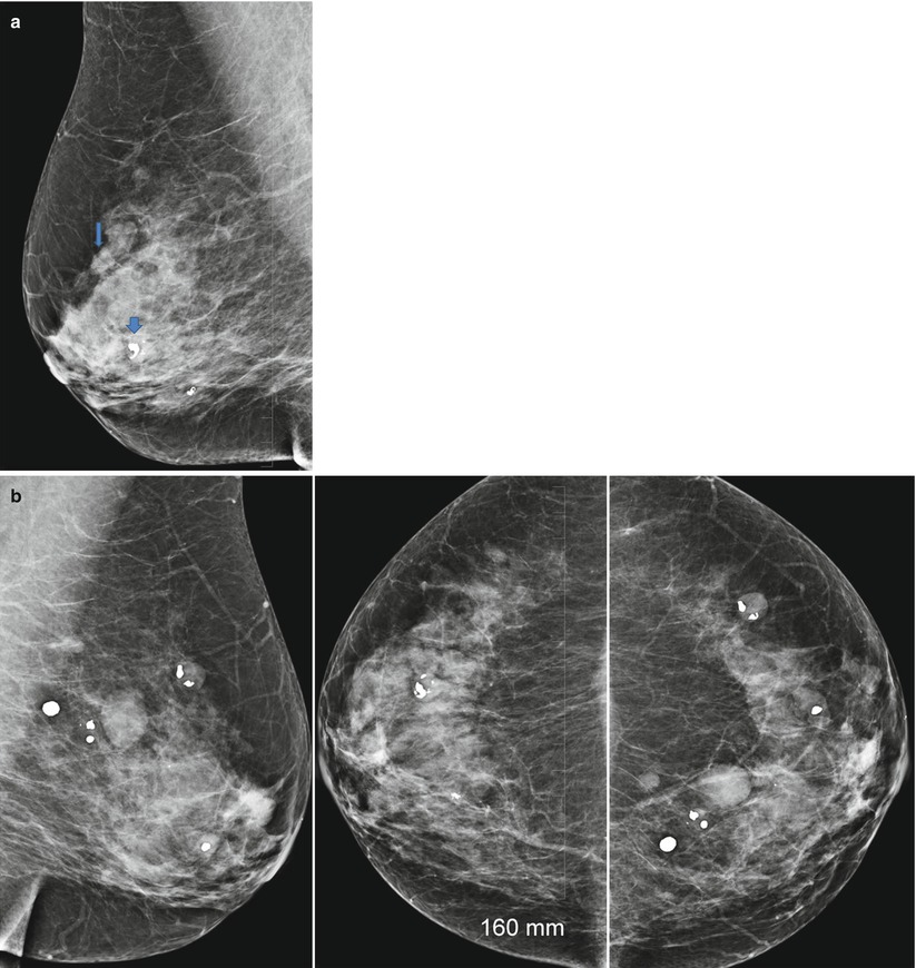 Probably Benign Abnormalities of the Breast SpringerLink