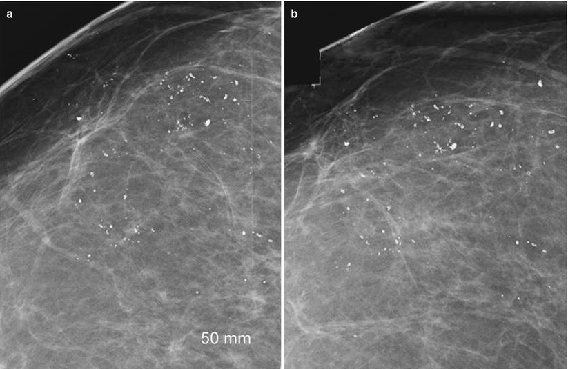 Probably Benign Abnormalities of the Breast SpringerLink