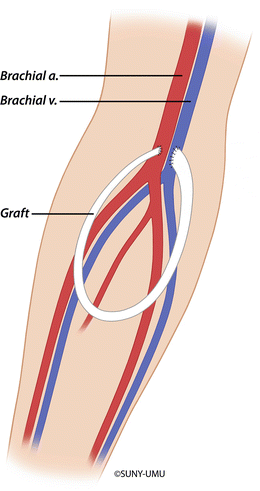 Arteriovenous Hemodialysis Access | SpringerLink