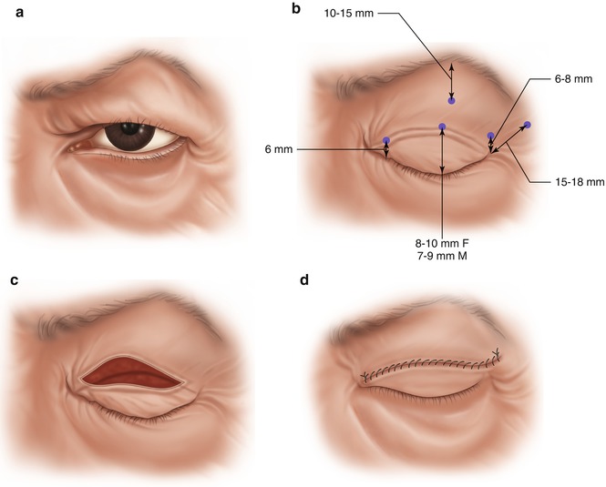 Incisional Guidelines When Marking the Skin in Upper Eyelid Blepharoplasty | SpringerLink