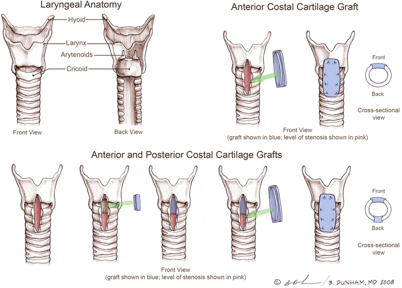 Neonatal Subglottic Stenosis SpringerLink