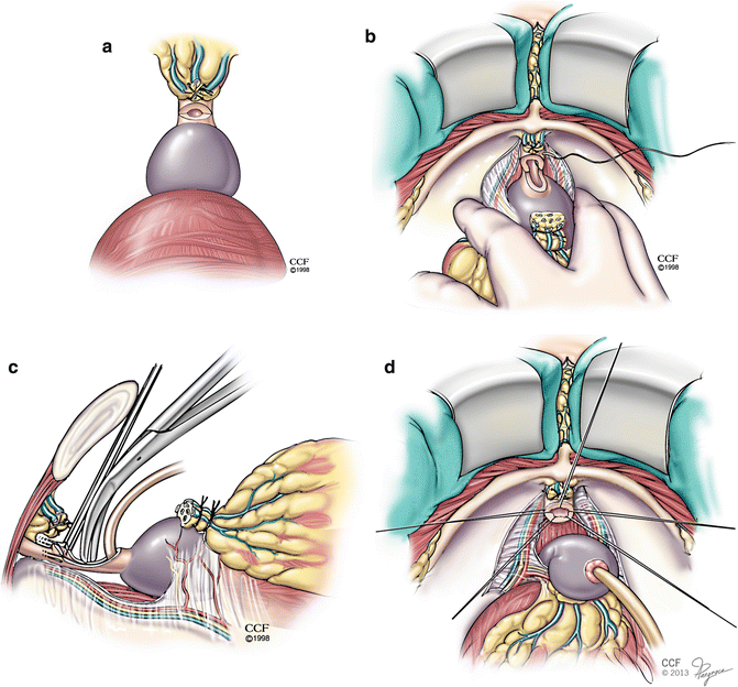 Open Radical Retropubic Prostatectomy and Pelvic Lymph Node Dissection