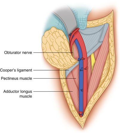 The Surgical Importance Of The Inferior Epigastric Vessels Springerlink