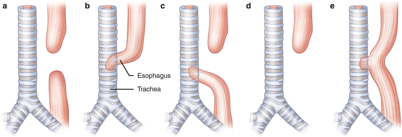 Pediatric Anesthesia Springerlink