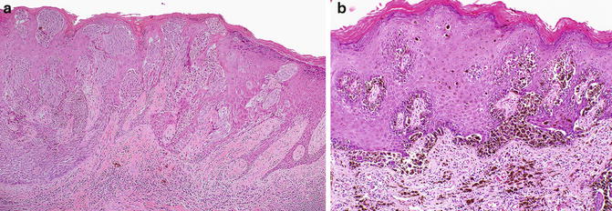 Malignant Melanoma Of The Vulva | SpringerLink