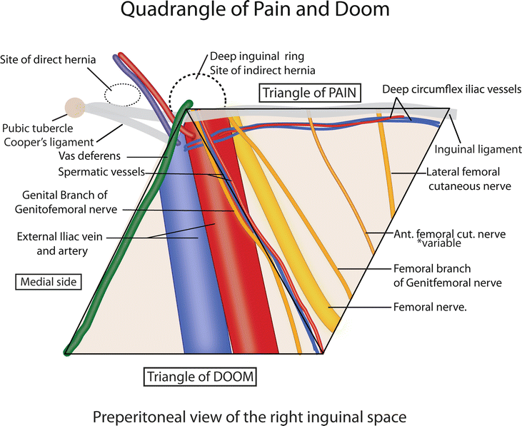 Lap inguinal hernia landmarks