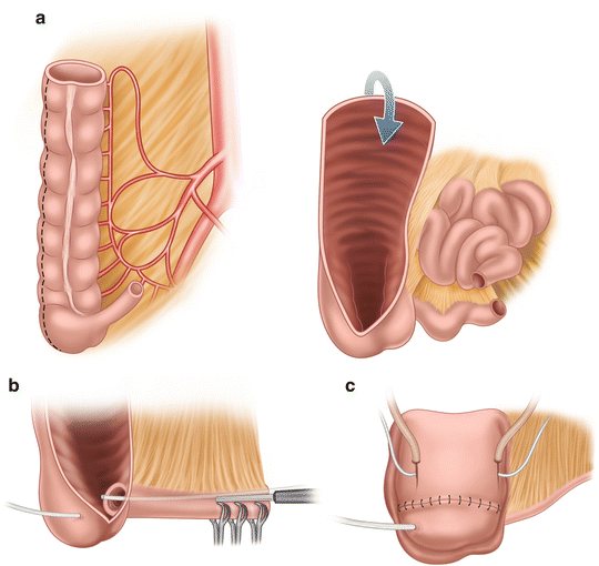 Urinary Diversion Open and Robotic Techniques SpringerLink
