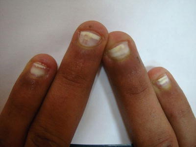 Nail Diseases Among Renal Patients Springerlink