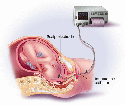 internal fetal heart monitor