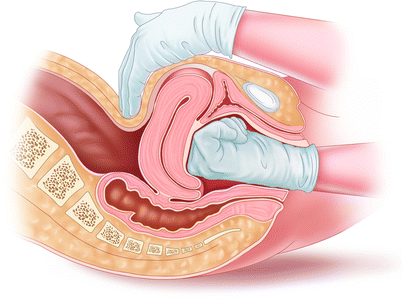 Management Of Primary Postpartum Hemorrhage Springerlink