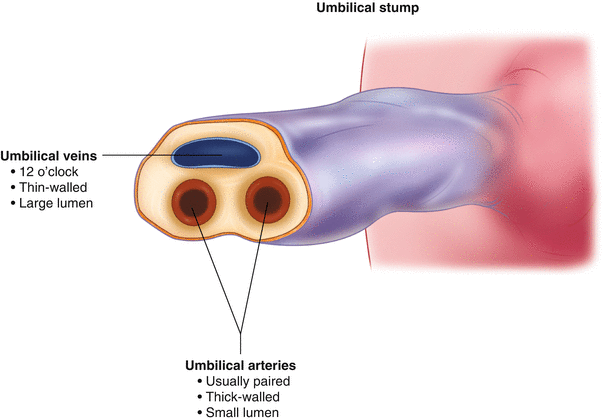 Umbilical Venous Catheters Insertion And Removal Springerlink Umbilical Venous Catheters Insertion And Removal Springerlink