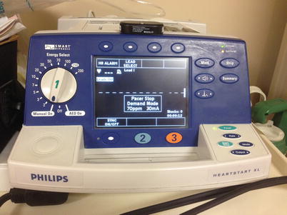 Transcutaneous Pacing | SpringerLink
